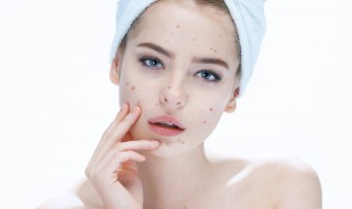 祛痘印好方法（祛痘印方法苗医生团队在那里呢）