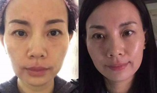 美容除皱方法（美容除皱方法有哪几种）