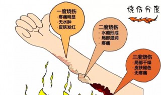 烧伤怎么处理好的快（怎么治烧伤好得快）