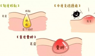 怎样处理青春痘 怎样处理青春痘不会有痘印