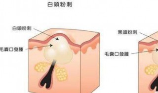 脸上粉刺闭口怎样消除（脸上粉刺闭口怎样消除最有效）